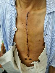 心脏外科特色技术之微创心脏手术