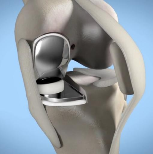 给膝关节补牙骨科开展单髁置换术微创解决老年患者膝关节疼痛问题